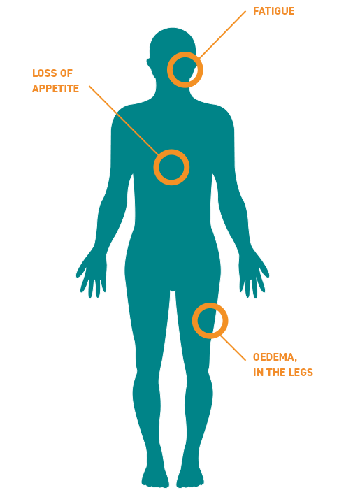 AA Amyloidosis