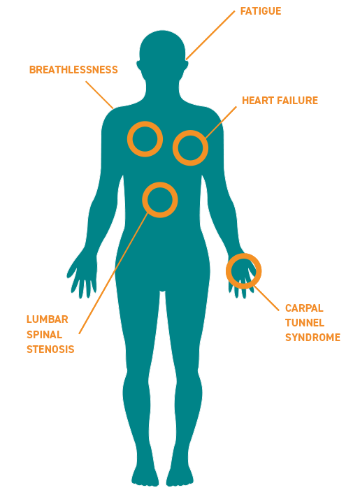 wt_TTR Amyloidosis